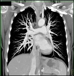 VRT-MIP of Pulmonary Vessels - CTisus CT Scan