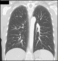 Granuloma Left Lower Lobe - CTisus CT Scan