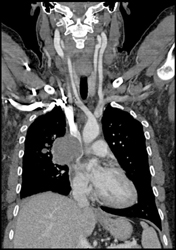 Non Small Cell Lung Cancer Compresses SVC - CTisus CT Scan