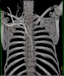 Dilated Azygos Vein Due to SVC Compression - CTisus CT Scan