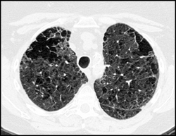 Lung Cysts With Interstitial Disease - CTisus CT Scan