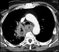 Esophageal Cancer Invades the Lung - CTisus CT Scan
