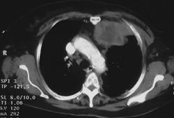 Metastatic Tumor to Lung - CTisus CT Scan