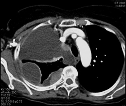 Loculated Malignant Effusion - CTisus CT Scan