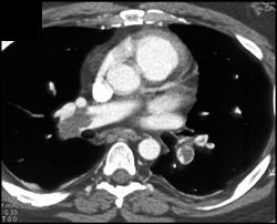 Bilateral Pulmonary Embolism With Deep Vein Thrombosis (DVT) in Left Femoral Vein - CTisus CT Scan