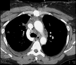 Lung Cancer-NSCLC-invades the SVC - CTisus CT Scan