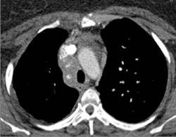 Collapse of Right Middle Lobe (RML) Due to Encasement of Right Middle Lobe Bronchus By Tumor and Adenopathy - CTisus CT Scan