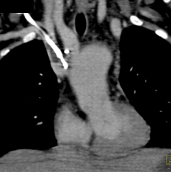 Clot in Right Subclavian Vein - CTisus CT Scan