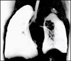 Narrowed Left Mainstem Bronchus and Small Left Lung - CTisus CT Scan