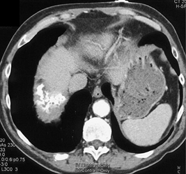 Plaques Due to Asbestos Exposure - CTisus CT Scan