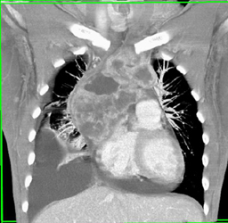 Lymphoma - CTisus CT Scan