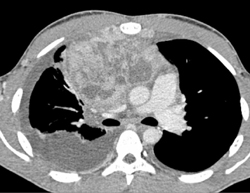 Lymphoma - CTisus CT Scan