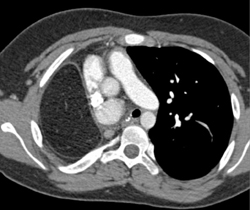 Absent Right Pulmonary Artery - CTisus CT Scan