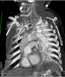 Stent in Aorta - CTisus CT Scan