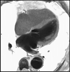 Aortic Dissection - CTisus CT Scan