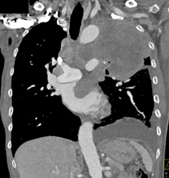 Lung Cancer Invades the Left Atrium - CTisus CT Scan