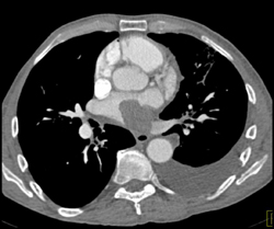 Lung Cancer Invades the Left Atrium - CTisus CT Scan