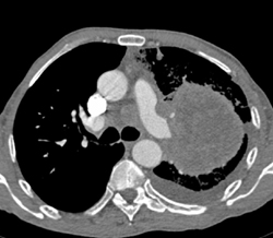 Lung Cancer Invades the Left Atrium - CTisus CT Scan