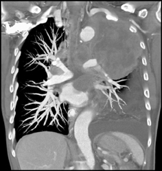 Lung Cancer Invades the Left Atrium - CTisus CT Scan