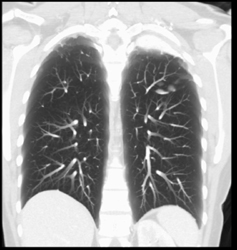 Thick Left Pleural Cap - CTisus CT Scan