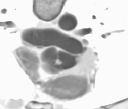 Tumor in LV and Clot Off Aortic Valve in Intravenous Drug Abuse (IVDA) Patient - CTisus CT Scan