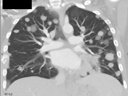Lung Metastases Secondary to H and N Cancer - CTisus CT Scan