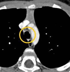 Tracheal Papillomatosis Shown in Many Different Ways - CTisus CT Scan
