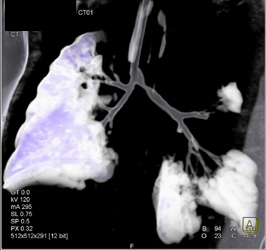 Tracheal Stenosis in A 3 Year Old - CTisus CT Scan