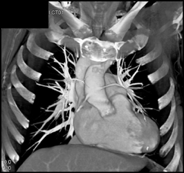 Saphenous Bypass Grafts - CTisus CT Scan