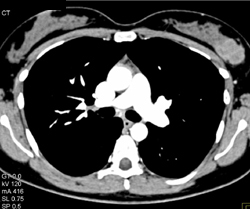 Breast Cancer-enhancing - CTisus CT Scan