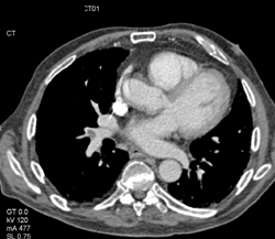 Pulmonary Embolism - CTisus CT Scan
