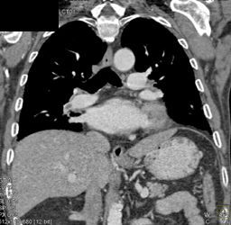 Pulmonary Embolism - CTisus CT Scan