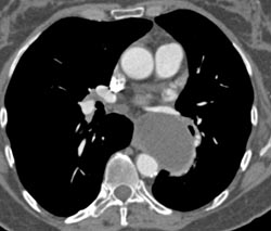 Bronchogenic Cyst - CTisus CT Scan