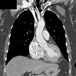 Bronchogenic Cyst - CTisus CT Scan