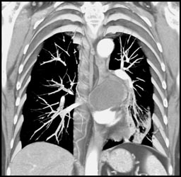 Bronchogenic Cyst - CTisus CT Scan