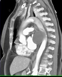 Bronchogenic Cyst - CTisus CT Scan