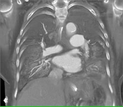 Hydropneumothorax - CTisus CT Scan