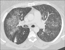 Aspiration of Drugs in the Bronchus Intermedius and Lung Fields - CTisus CT Scan