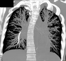 Broken Catheter in Right Lower Lobe - CTisus CT Scan