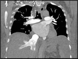 Reflux of Contrast Into Inferior Vena Cava (IVC) - CTisus CT Scan