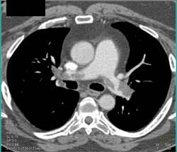 Pulmonary Embolism - CTisus CT Scan