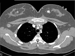 Pleural Mets - CTisus CT Scan