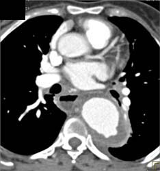 Aortic Aneurysm With Ulceration - CTisus CT Scan