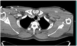 Bleed in Left Pectoralis Muscle - CTisus CT Scan