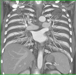 Lung Mass - CTisus CT Scan
