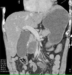 Lung Cancer Metastatic to the Pancreas - CTisus CT Scan