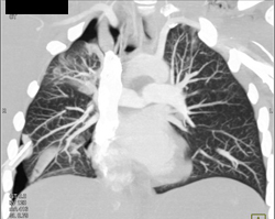 Trauma With Right Pneumothorax - CTisus CT Scan