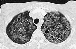 PCP Pneumonia - CTisus CT Scan