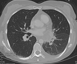 Lung Cancer Invades the Left Atrium - CTisus CT Scan