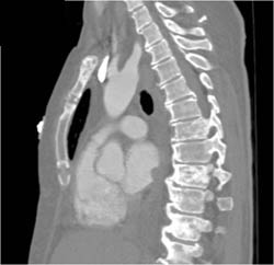 Lung Cancer Invades the Left Atrium - CTisus CT Scan